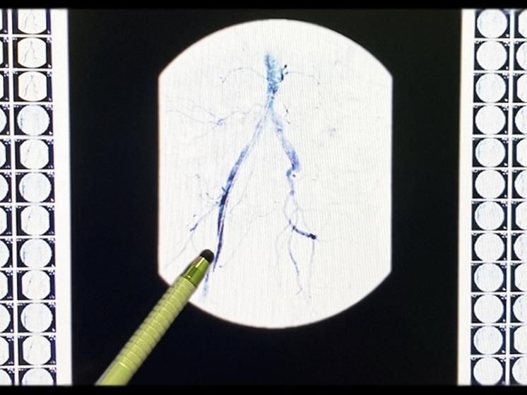 Рязанские врачи прооперировали 51-летнего пациента с инфарктом миокарда