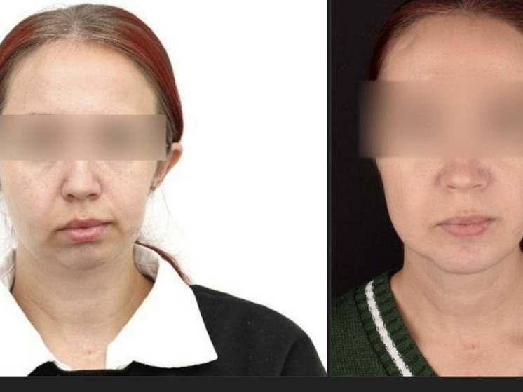 Красноярские хирурги провели уникальную операцию по реконструкции челюсти