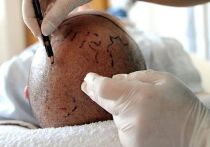 Британец скончался в Стамбуле спустя несколько часов после пересадки волос и стоматологического лечения