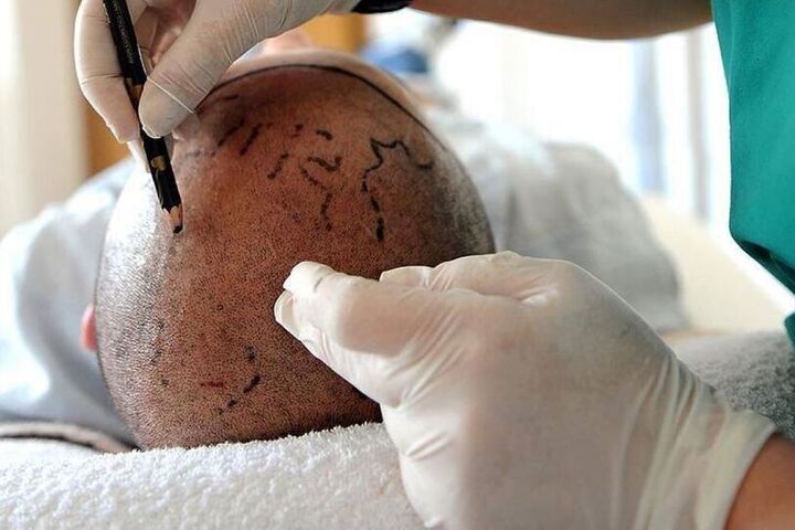 Мужчина умер после пересадки волос и лечения зубов