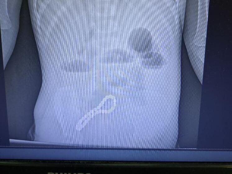 В Рязани хирурги спасли трёхлетнего малыша, проглотившего магнитный браслет