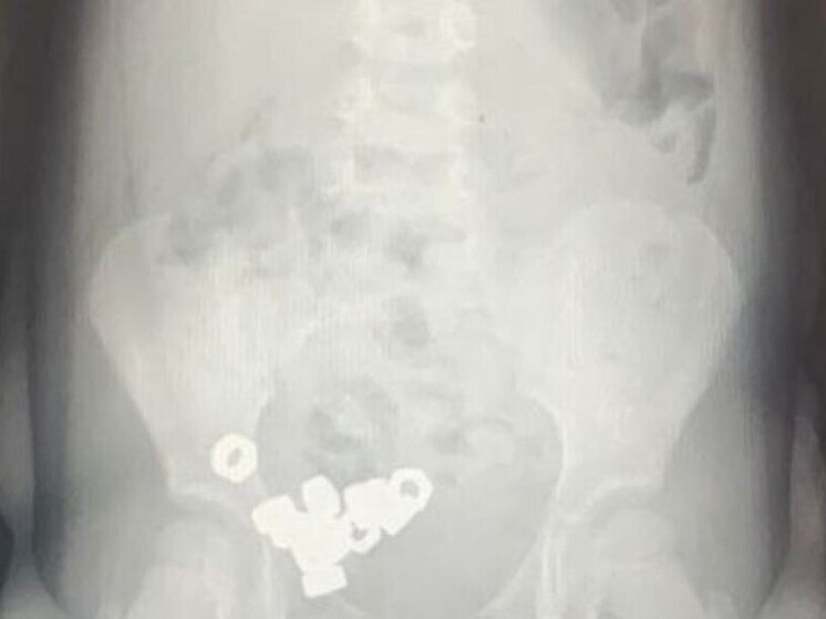 В Воронеже 3-летний малыш съел 16 гаек