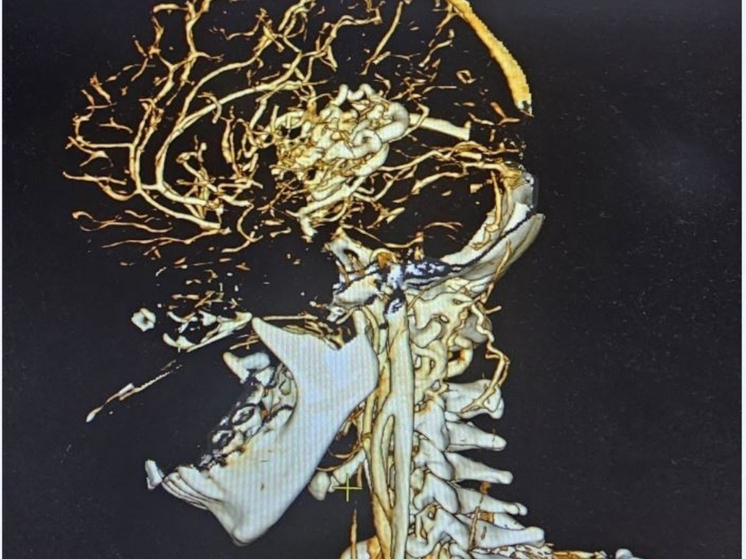 Орловские врачи спасли жизнь подростку с кровоизлиянием в мозг