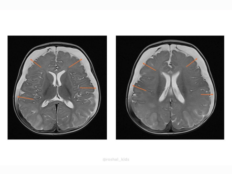Девочку с редким генетическим заболеванием спасли врачи Детского научно-клинического центра Рошаля