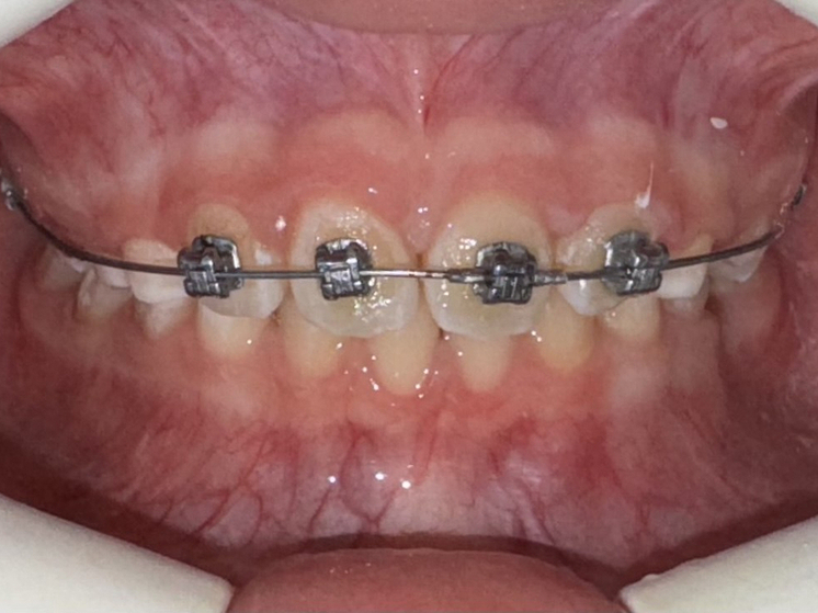 Преимущества частичной брекет-системы назвали псковские стоматологи