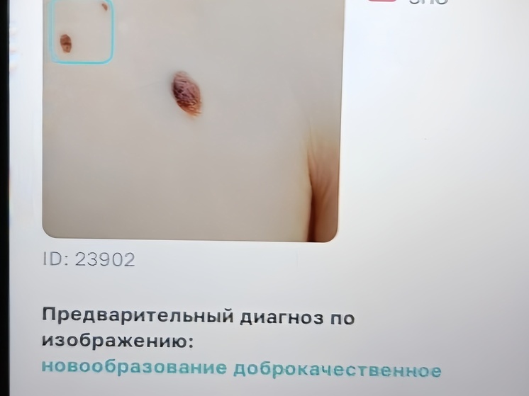 Проверять родинки нижегородским медикам помогает ИИ