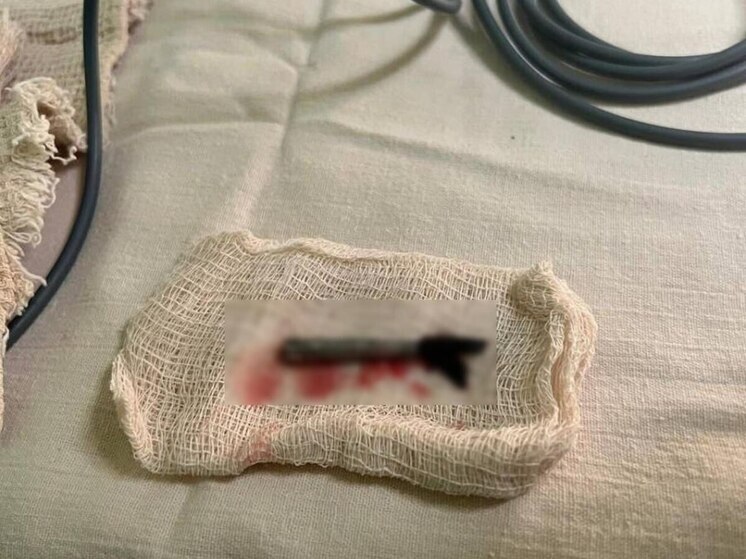 В Саратове дети проглотили опасные предметы