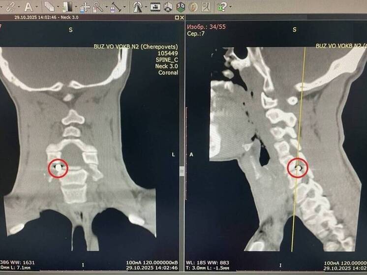 Вологодские нейрохирурги извлекли осколок снаряда из позвоночника бойца СВО