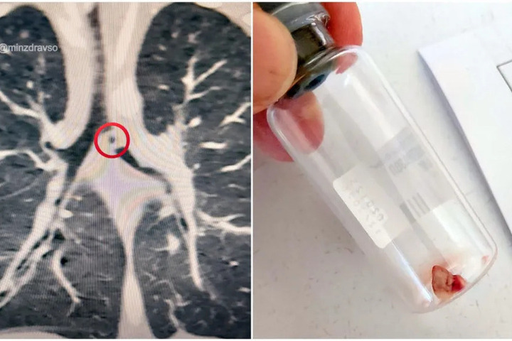 Годовалый мальчик из Екатеринбурга проглотил глину и оказался на ИВЛ