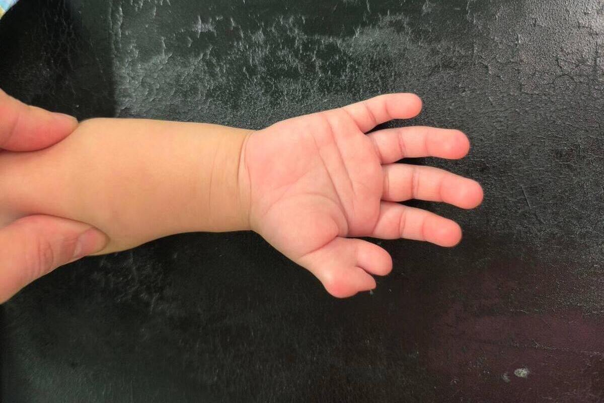 Трехлетнему ребенку удалили лишний палец