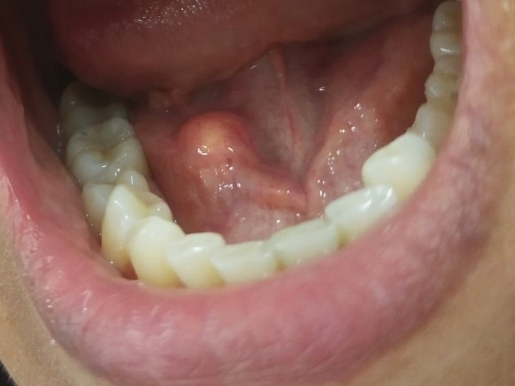 В Чебоксарах пациентке удалили слюнной камень размером с вишню