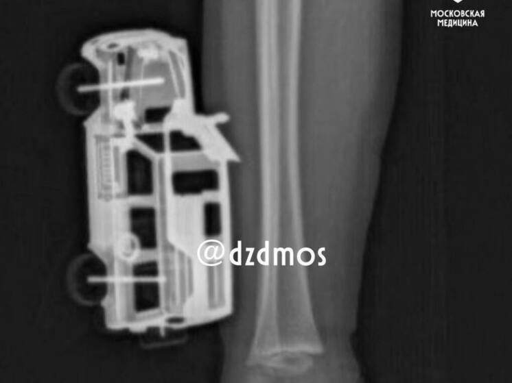 В Москве медики удалили из ноги 4-летнего пациента игрушечную машинку