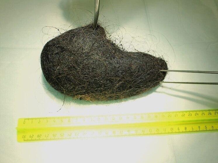 В Барнауле врачи спасли жизнь 13-летней девочке с редкой патологией, известной как синдром Рапунцель