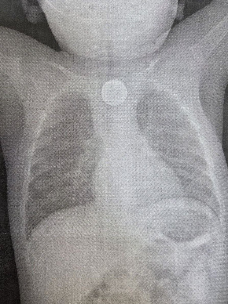 Врачи ДРКБ в Бурятии спасли годовалого ребенка, проглотившего батарейку и монету