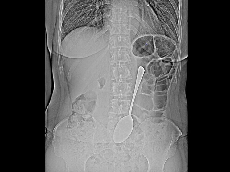 Врачи БСМП в Улан-Удэ извлекли из желудка пациентки столовую ложку