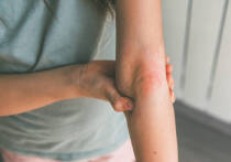 Новое глобальное исследование, основанное на данных за три десятилетия, показывает, что заболеваемость псориазом во всем мире неуклонно растет, причем наиболее высокое бремя болезни приходится на экономически развитые регионы, такие как Северная Америка и Западная Европа