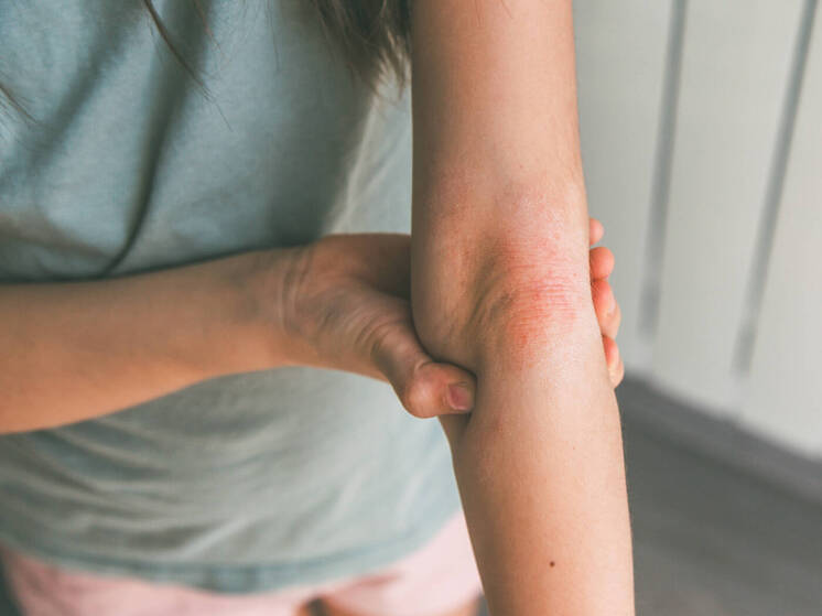 Новое глобальное исследование, основанное на данных за три десятилетия, показывает, что заболеваемость псориазом во всем мире неуклонно растет, причем наиболее высокое бремя болезни приходится на экономически развитые регионы, такие как Северная Америка и Западная Европа