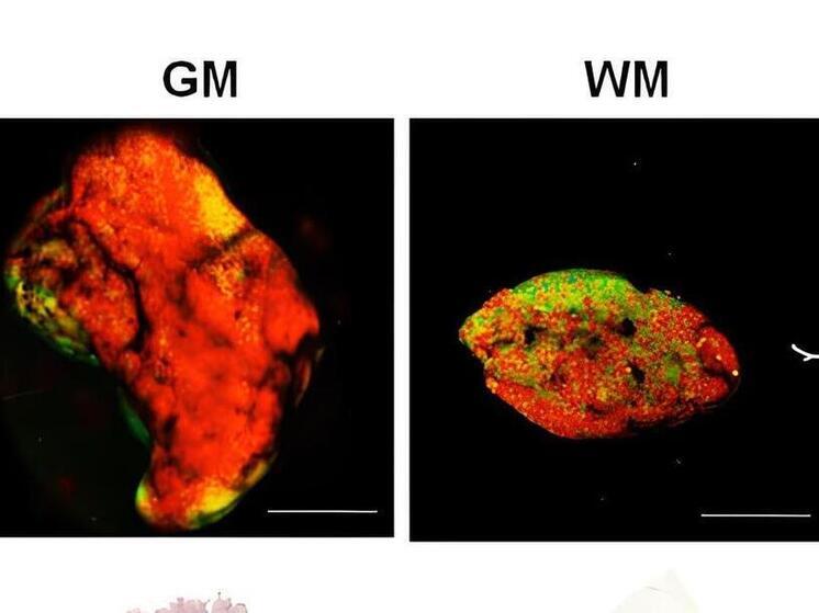 Нижегородские ученые определяют опухоль мозга по свечению тканей
