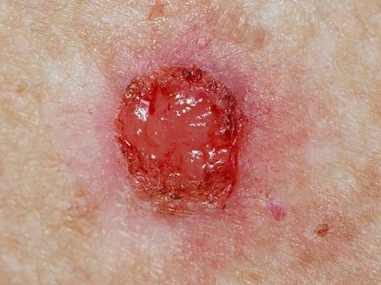 Маленькая ранка на носу пенсионерки оказалась злокачественным образованием