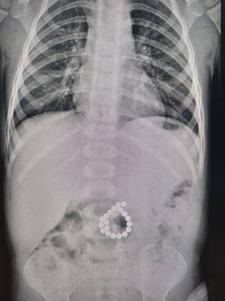 Опасная игрушка: в Югре двухлетний ребёнок проглотил магниты