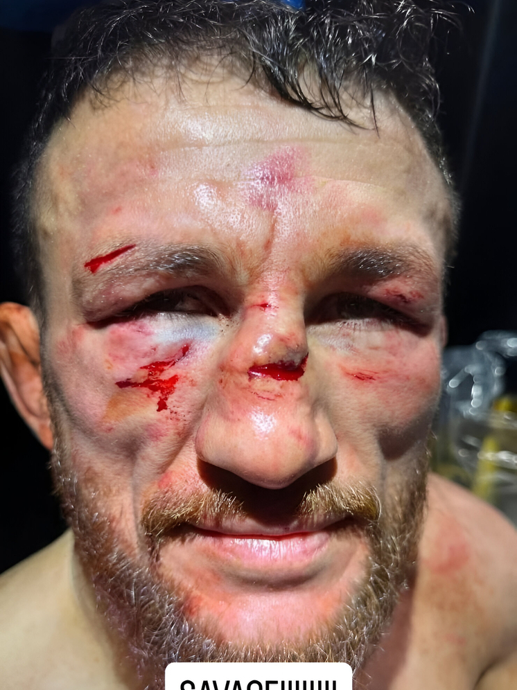 Боец Двалишвили снял на фото лицо после поражения от Яна в титульном реванше UFC