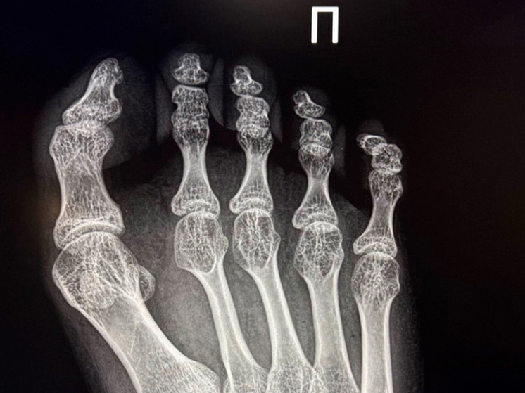 В Липецкой области успешно проведена операция для подростка с ДЦП