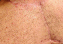 Липому размером с арбуз удалили со спины мужчины московские хирурги