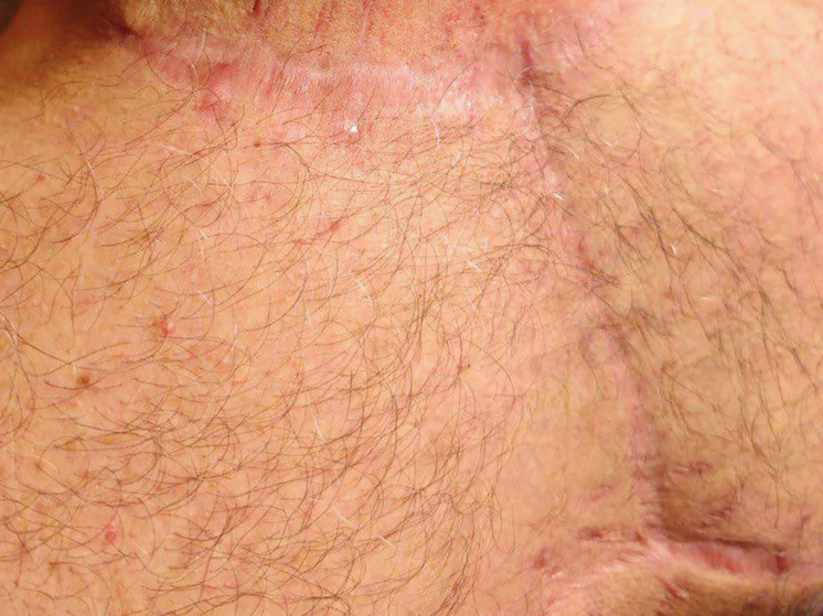 Липому размером с арбуз удалили со спины мужчины московские хирурги