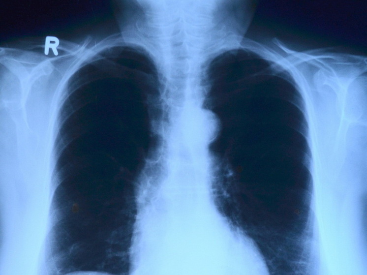 Мясников о рентгене при пневмонии: зачем делать, если это бесполезно?