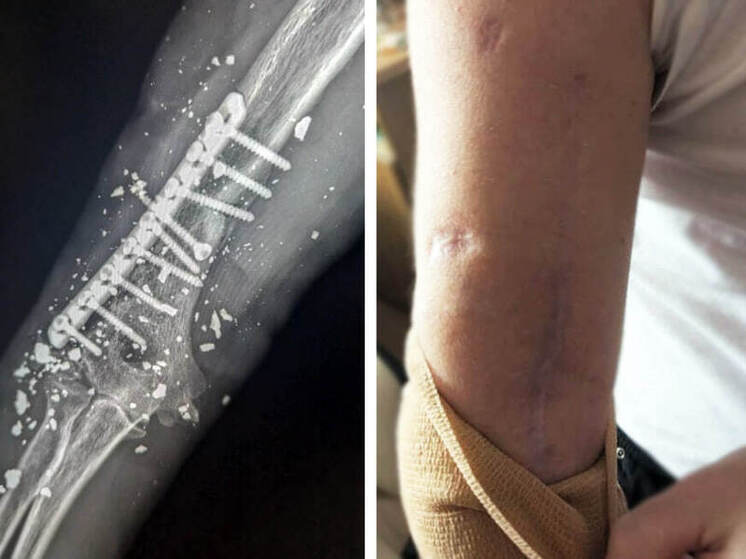 В Рязанской ОКБ помогли пациенту с минно-взрывным ранением