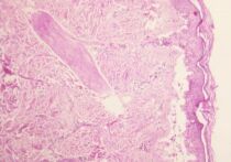 Девочку с крайне редкой аллергической реакцией на лекарства спасли подмосковные врачи