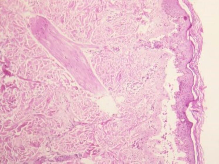 Врачи спасли девочку от редкого синдрома Стивенса-Джонсона