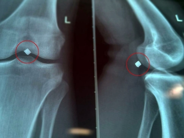 В ОКБ спасли 22-летнего рязанца с осколком под коленом