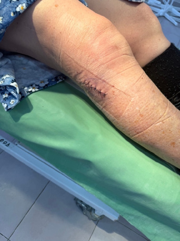 Во Владимире из колена 70-летней женщины извлекли гигантскую опухоль