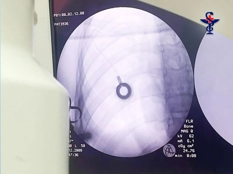 В детской больнице Астрахани впервые установили порт-систему маленькому пациенту с онкологией