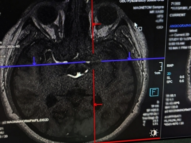 В Рязани спасли 24-летнего пациента с инсультом