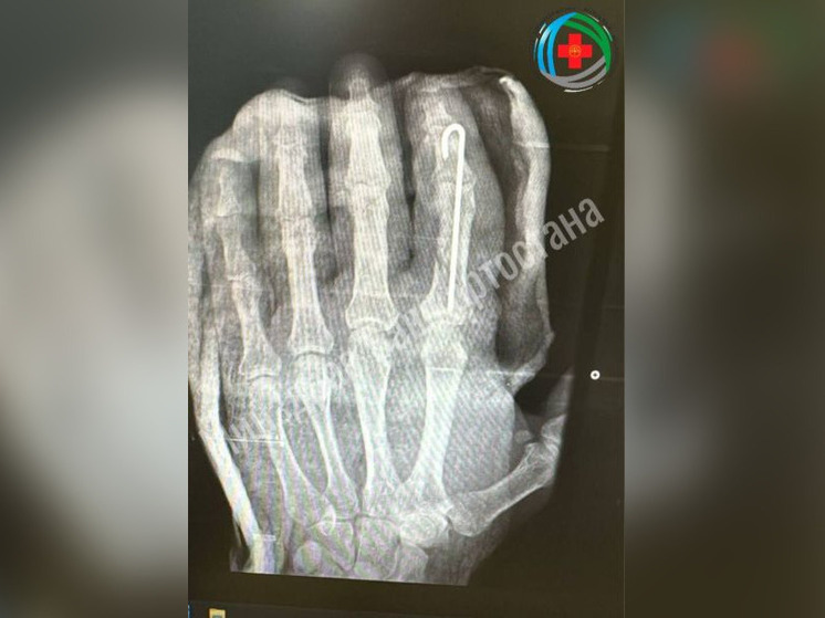 В Башкирии хирурги успешно восстановили пациенту ампутированный палец