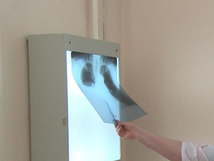 Длительный кашель может сигнализировать о туберкулезе — новосибирский фтизиатр предупреждает о скрытом течении болезни