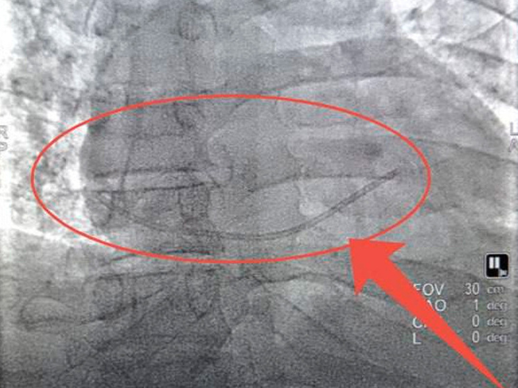 Липецкие врачи спасли жизнь пациенту с катетером в сердце