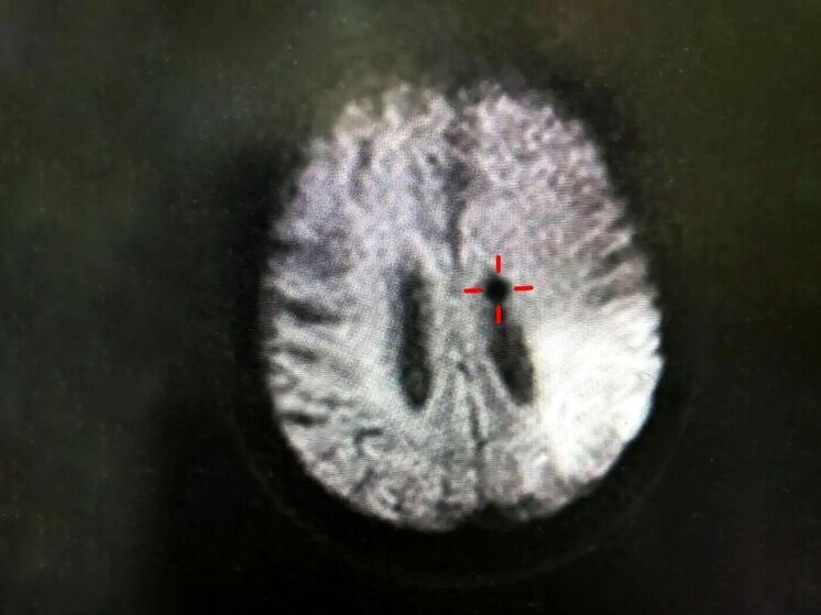 В Рязанской ОКБ спасли пациента с нарушением мозгового кровообращения