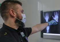 Импланты нового уровня для восстановления сломанных костей придумали учёные пермского Политеха