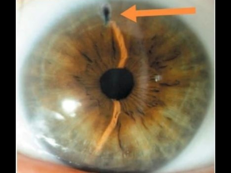 В Орловской областной клинической больнице спасли зрение пациентке