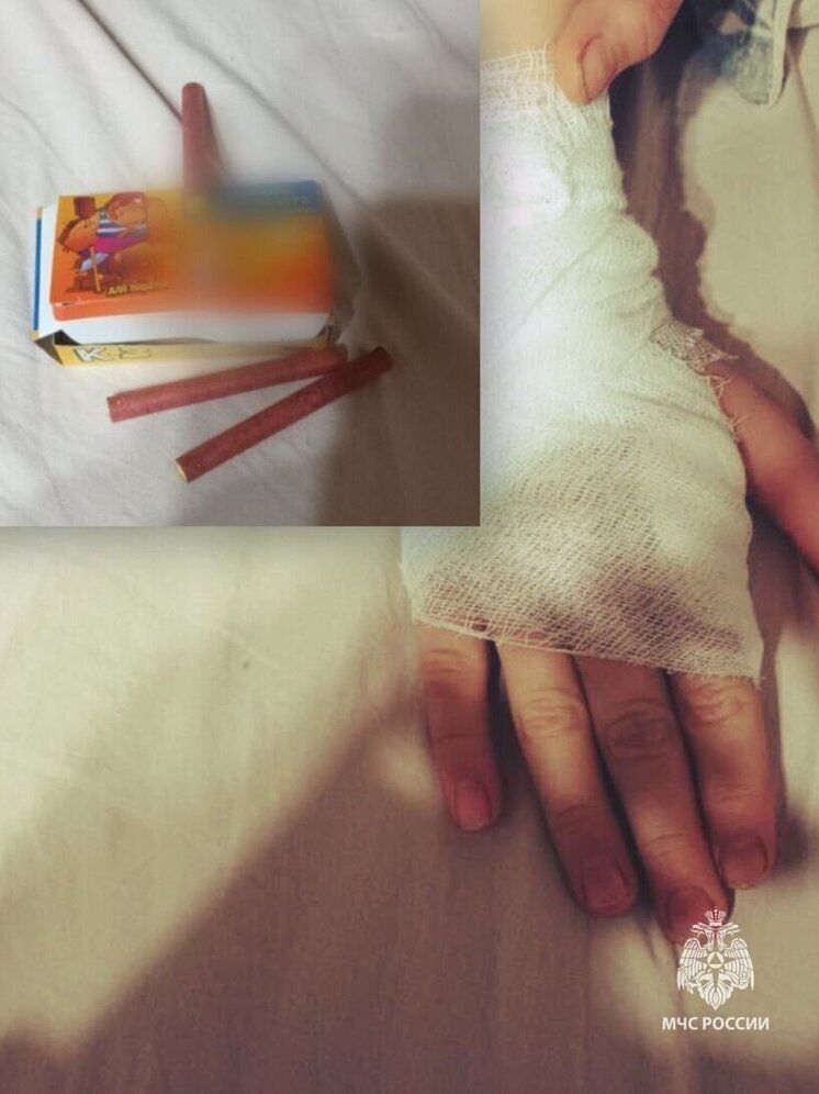 В Удмуртии зафиксирован первый в этом сезоне случай ожога от петарды