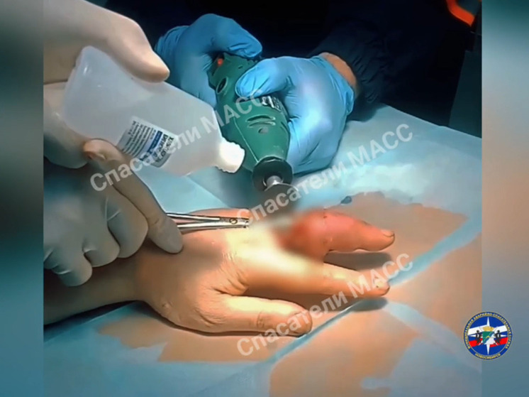 В Новосибирске спасатели и хирурги совместно боролись за палец пациента