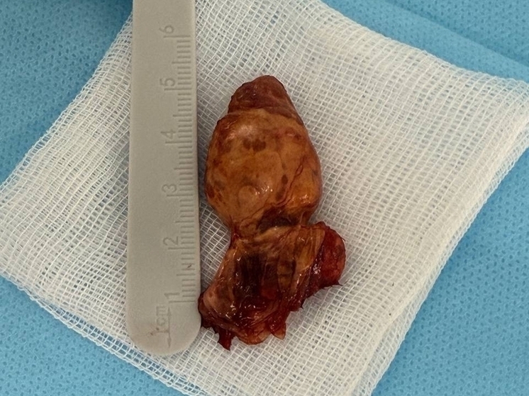 Детские хирурги в Липецке успешно провели сложную микрохирургическую операцию