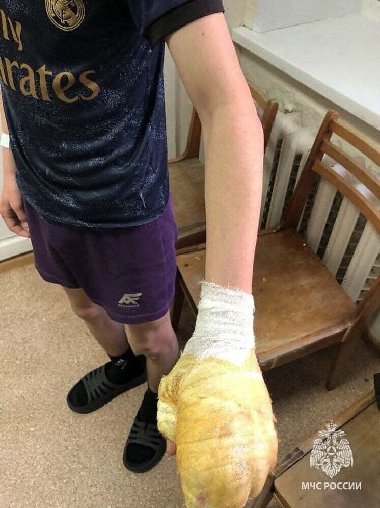 В Ижевске дети пострадали от взрывов петард в первый день года