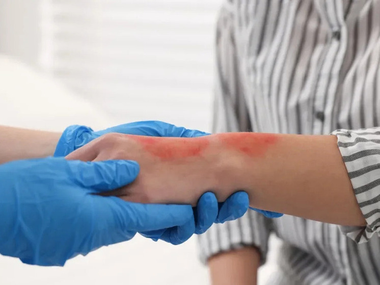 Жителям Калмыкии дали рекомендации при ожогах