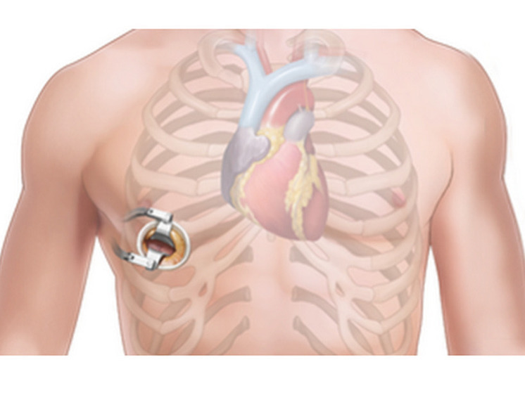 В Чувашии кардиохирурги продолжают осваивать малоинвазивные операции