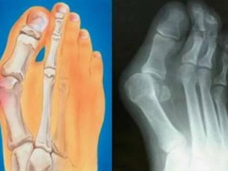 Ортопед рассказал, почему появляется косточка на стопе и как ее лечат