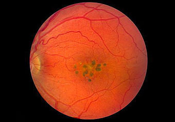 Ранее ученые считали, что все болезни глаз уже известны